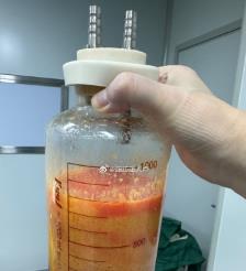 鄂尔多斯水动力吸脂手术要做多久？